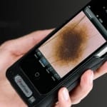 El iPhone también sirve para analizar manchas en la piel