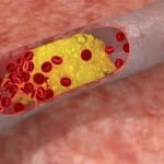 Medicamentos contra el colesterol reducen también la placa arterial