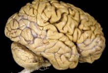 Los antipsicóticos pueden reducir el tamaño del cerebro