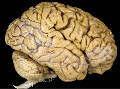 Los antipsicóticos pueden reducir el tamaño del cerebro