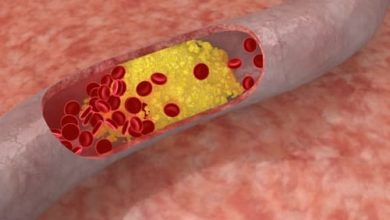 Medicamentos contra el colesterol reducen también la placa arterial