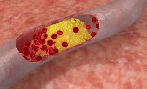 Medicamentos contra el colesterol reducen también la placa arterial